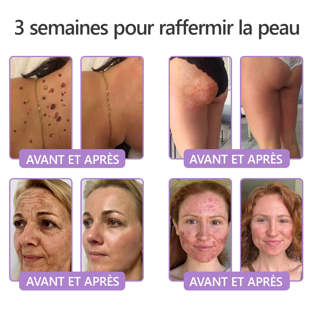 HISKIN® Crème corps roller PDRN Multi-Peptides 🌹— anti-âge, hydratante, raffermissante, effet liftant, aide à réparer la peau, unifier le teint, cibler boutons, taches, verrues, grains de beauté et psoriasis.