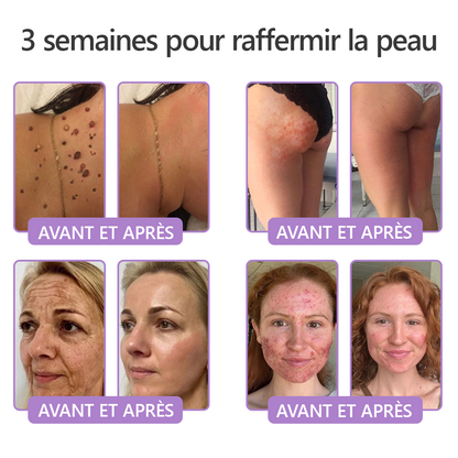 HISKIN® Crème corps roller PDRN Multi-Peptides 🌹— anti-âge, hydratante, raffermissante, effet liftant, aide à réparer la peau, unifier le teint, cibler boutons, taches, verrues, grains de beauté et psoriasis.
