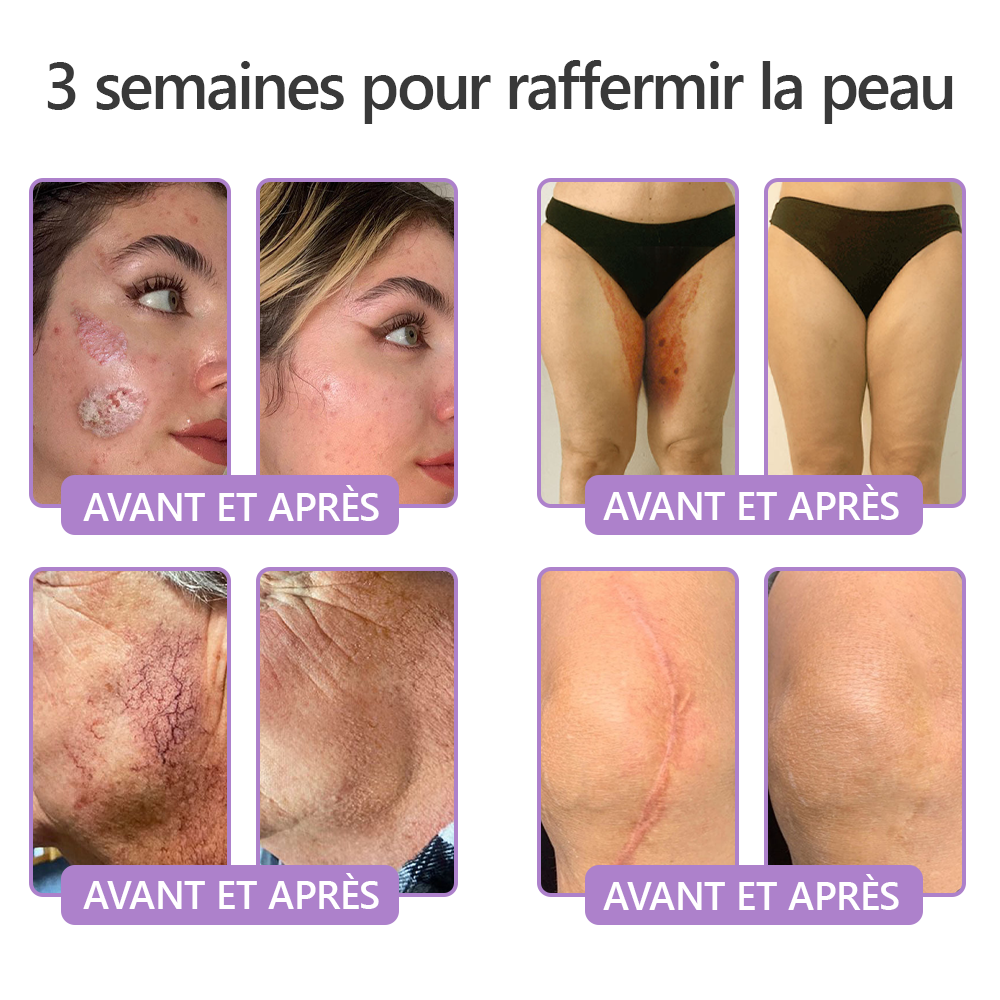 HISKIN® Crème corps roller PDRN Multi-Peptides 🌹— anti-âge, hydratante, raffermissante, effet liftant, aide à réparer la peau, unifier le teint, cibler boutons, taches, verrues, grains de beauté et psoriasis.