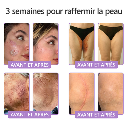 HISKIN® Crème corps roller PDRN Multi-Peptides 🌹— anti-âge, hydratante, raffermissante, effet liftant, aide à réparer la peau, unifier le teint, cibler boutons, taches, verrues, grains de beauté et psoriasis.