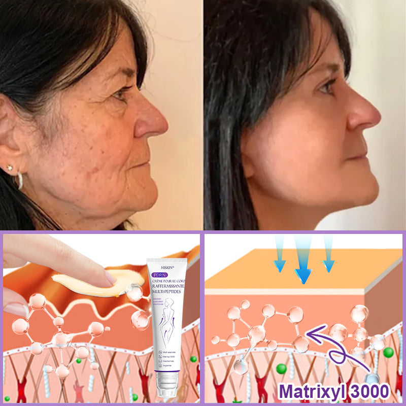 HISKIN® Crème corps roller PDRN Multi-Peptides 🌹— anti-âge, hydratante, raffermissante, effet liftant, aide à réparer la peau, unifier le teint, cibler boutons, taches, verrues, grains de beauté et psoriasis.